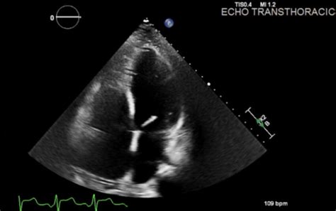 mildly dilated left ventricle symptoms